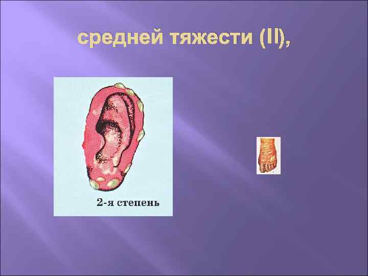 средней тяжести (II), 