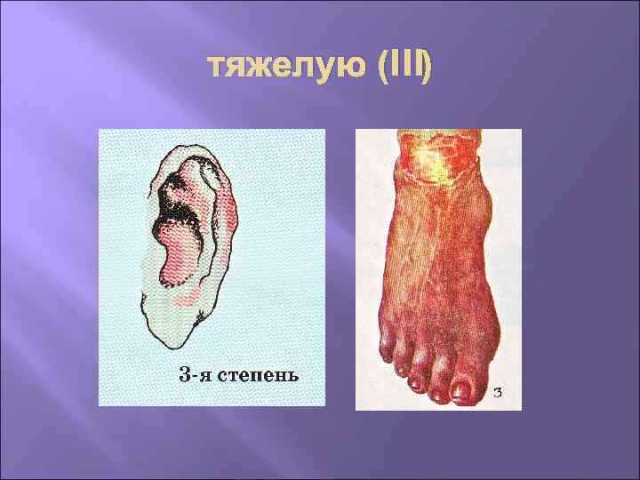 тяжелую (III) 