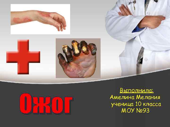 Ожог Выполнила: Амелина Мелания ученица 10 класса МОУ № 93 
