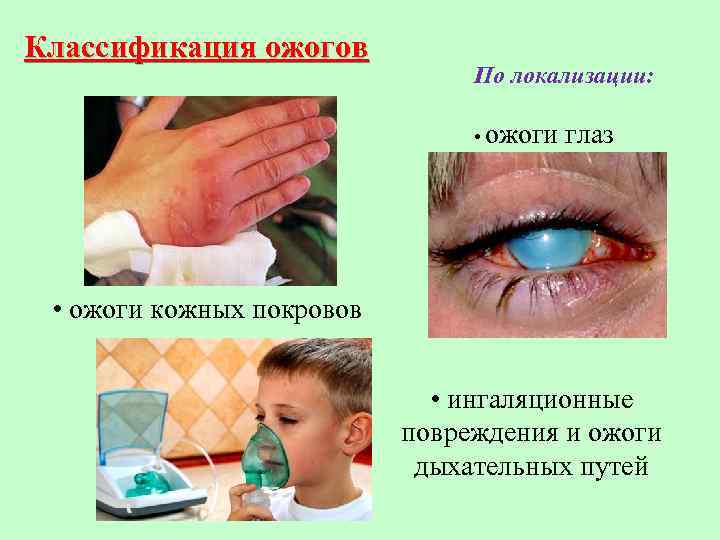Классификация ожогов По локализации: • ожоги глаз • ожоги кожных покровов • ингаляционные повреждения