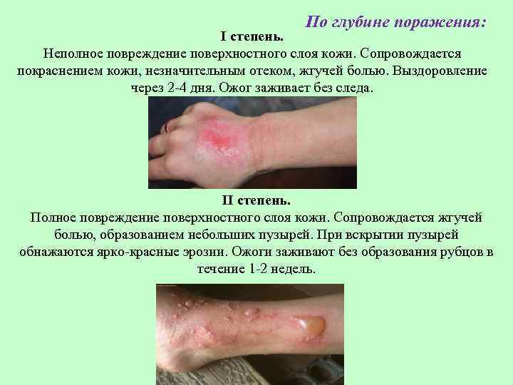 По глубине поражения: I степень. Неполное повреждение поверхностного слоя кожи. Сопровождается покраснением кожи, незначительным