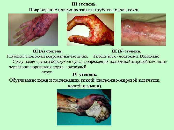 III степень. Повреждение поверхностных и глубоких слоев кожи. III (А) степень. III (Б) степень.
