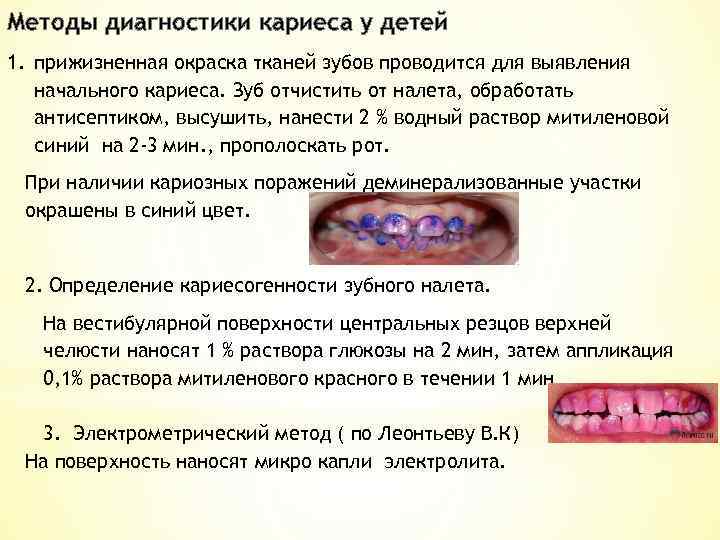 Методы диагностики кариеса у детей 1. прижизненная окраска тканей зубов проводится для выявления начального