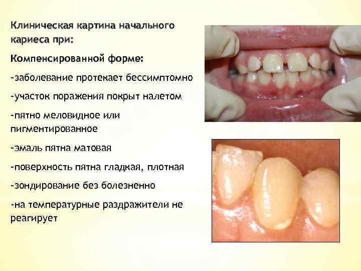 Клиническая картина начального кариеса при: Компенсированной форме: -заболевание протекает бессимптомно -участок поражения покрыт налетом