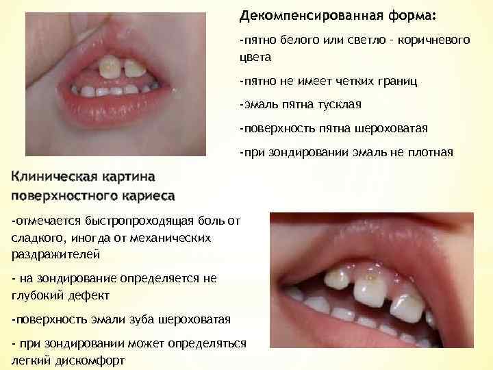 Декомпенсированная форма: -пятно белого или светло – коричневого цвета -пятно не имеет четких границ