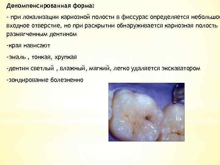 Декомпенсированная форма: - при локализации кариозной полости в фиссурас определяется небольшое входное отверстие, но