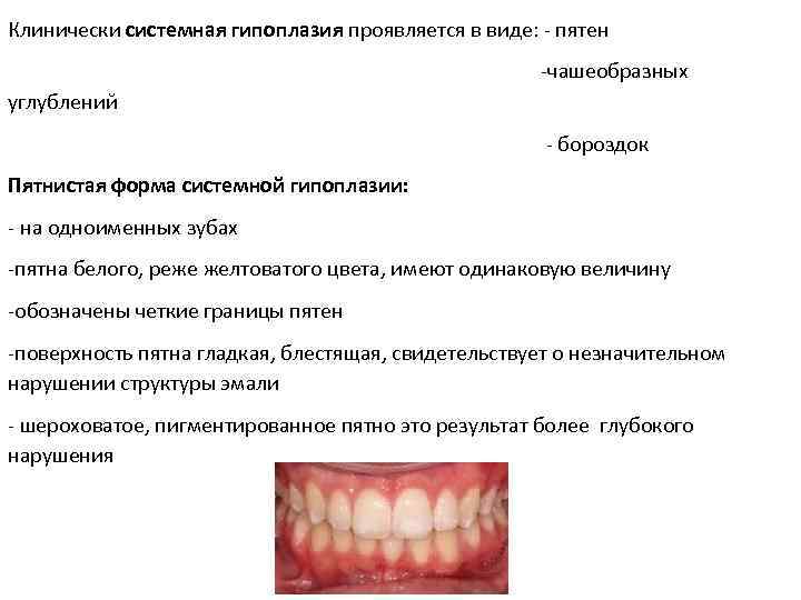 Заболеваниями сходными по клинической картине с гипоплазией эмали являются