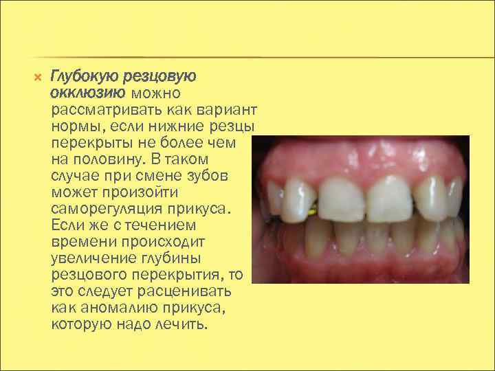  Глубокую резцовую окклюзию можно рассматривать как вариант нормы, если нижние резцы перекрыты не