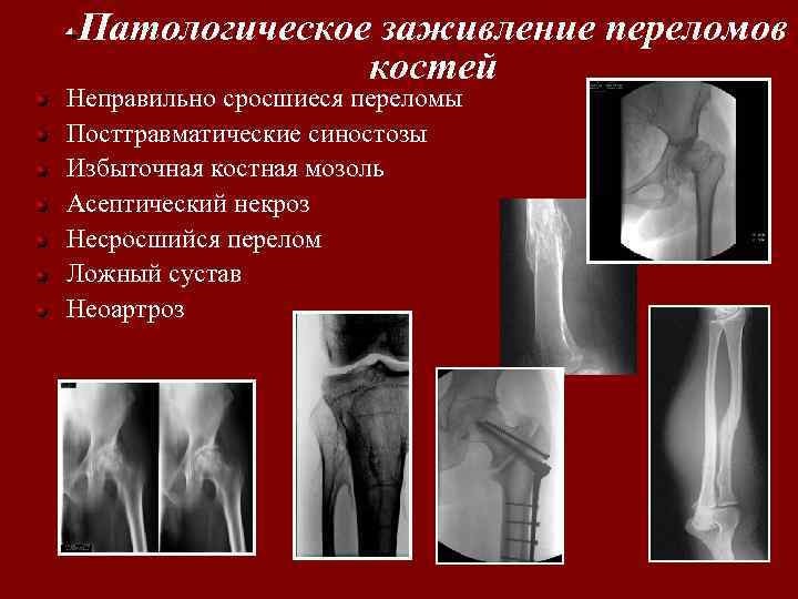 Патологическое заживление переломов костей Неправильно сросшиеся переломы Посттравматические синостозы Избыточная костная мозоль Асептический некроз