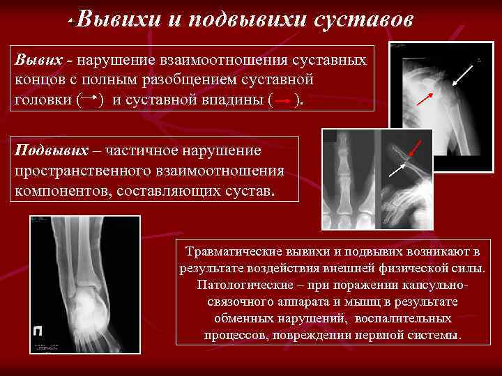Вывихи и подвывихи суставов Вывих - нарушение взаимоотношения суставных концов с полным разобщением суставной