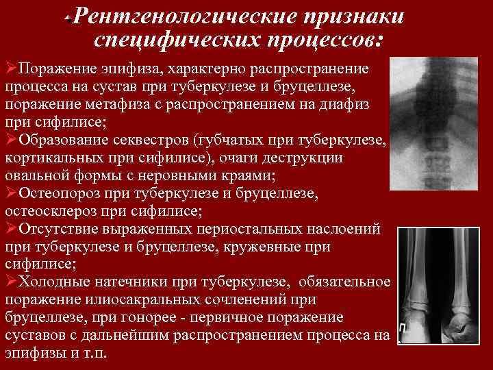 Рентгенологические признаки специфических процессов: ØПоражение эпифиза, характерно распространение процесса на сустав при туберкулезе и