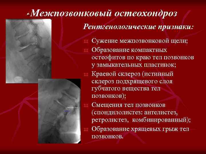 Межпозвонковый остеохондроз Рентгенологические признаки: Ш Ш Ш Сужение межпозвонковой щели; Образование компактных остеофитов по