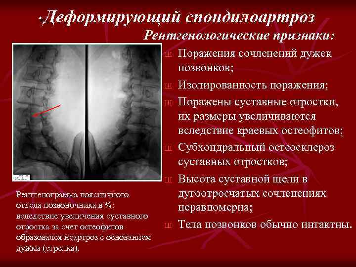 Деформирующий спондилоартроз Рентгенологические признаки: Ш Ш Ш Рентгенограмма поясничного отдела позвоночника в ¾: вследствие