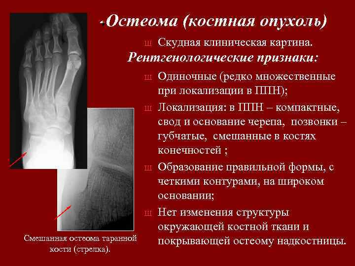 Остеома (костная опухоль) Ш Скудная клиническая картина. Рентгенологические признаки: Ш Ш Смешанная остеома таранной