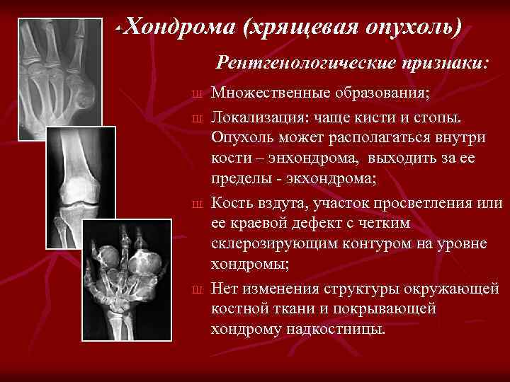 Хондрома (хрящевая опухоль) Рентгенологические признаки: Ш Ш Множественные образования; Локализация: чаще кисти и стопы.