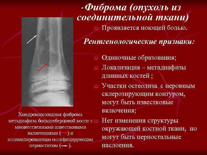 Фиброма (опухоль из соединительной ткани) Ш Проявляется ноющей болью. Рентгенологические признаки: Ш Ш Ш