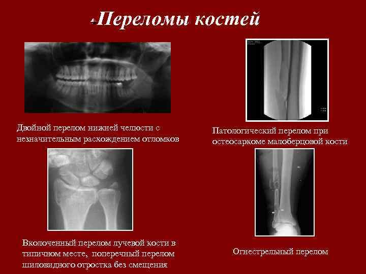 Перелом по типу зеленой ветки фото