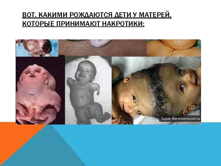 ВОТ, КАКИМИ РОЖДАЮТСЯ ДЕТИ У МАТЕРЕЙ, КОТОРЫЕ ПРИНИМАЮТ НАКРОТИКИ: 