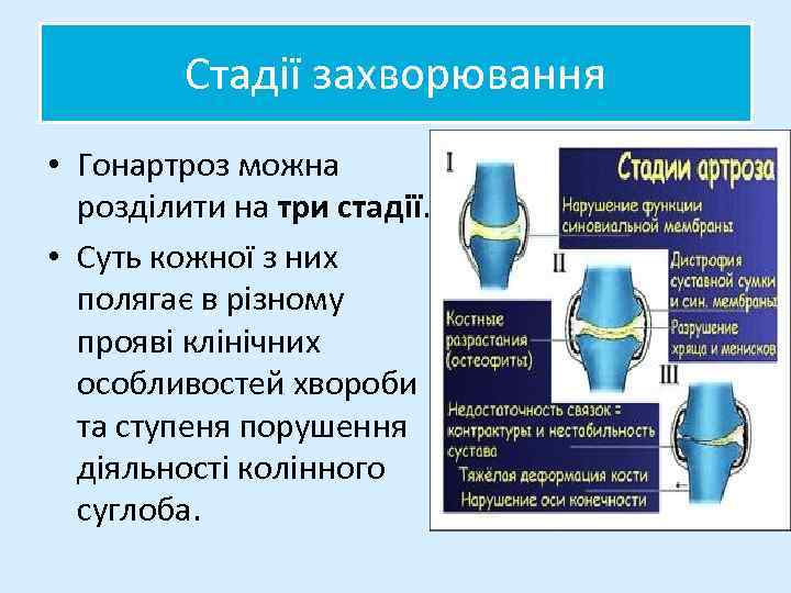 Стадії захворювання • Гонартроз можна розділити на три стадії. • Суть кожної з них