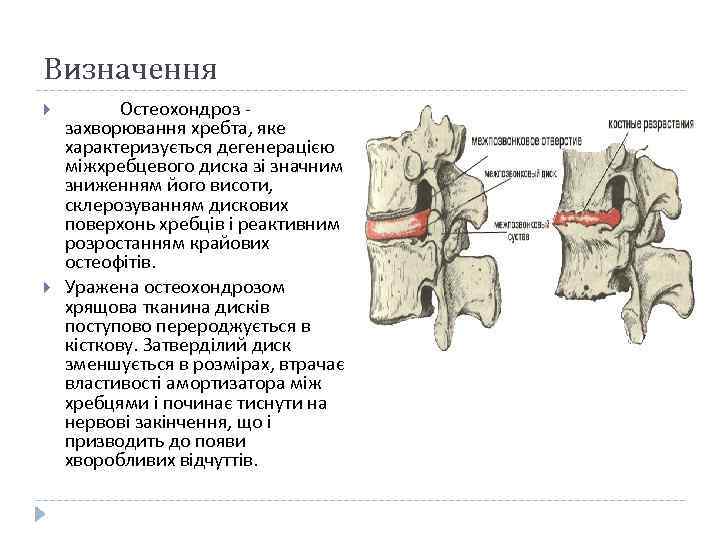 Визначення Остеохондроз - захворювання хребта, яке характеризується дегенерацією міжхребцевого диска зі значним зниженням його