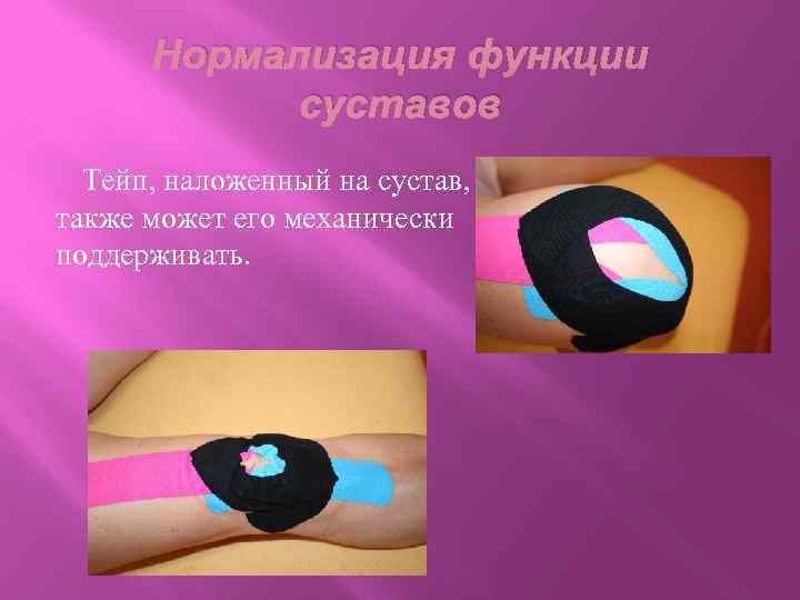 Нормализация функции суставов Тейп, наложенный на сустав, также может его механически поддерживать. 