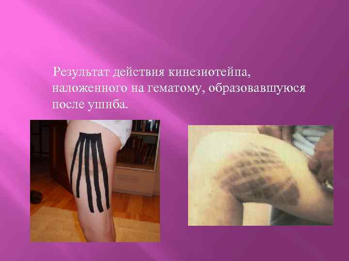  Результат действия кинезиотейпа, наложенного на гематому, образовавшуюся после ушиба. 