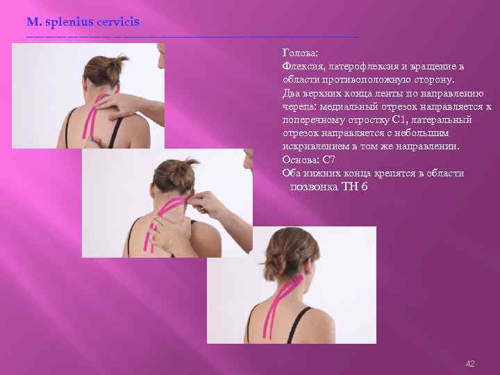 M. splenius cervicis ---------------------------------------------Голова: Флексия, латерофлексия и вращение в области противоположную сторону. Два верхних