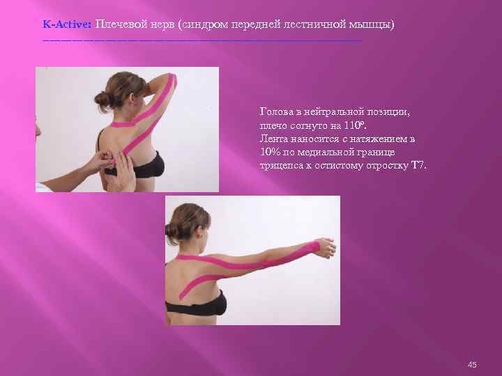 K-Active: Плечевой нерв (синдром передней лестничной мышцы) ------------------------------------------- Голова в нейтральной позиции, плечо согнуто