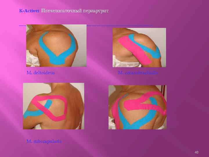 K-Active: Плечелопаточный периартрит ------------------------------------------- M. deltoideus M. coracobrachialis M. subscapularis 46 