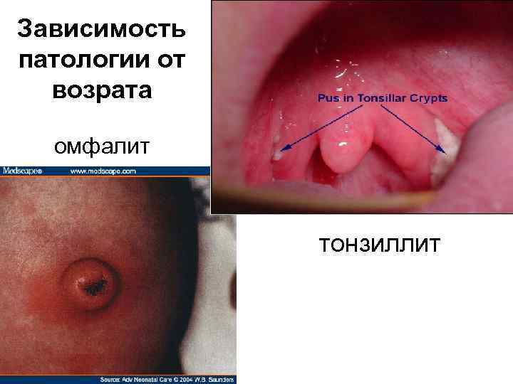 Зависимость патологии от возрата омфалит тонзиллит 