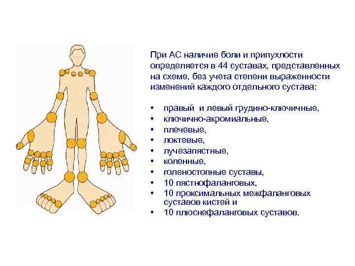 При АС наличие боли и припухлости определяется в 44 суставах, представленных на схеме, без