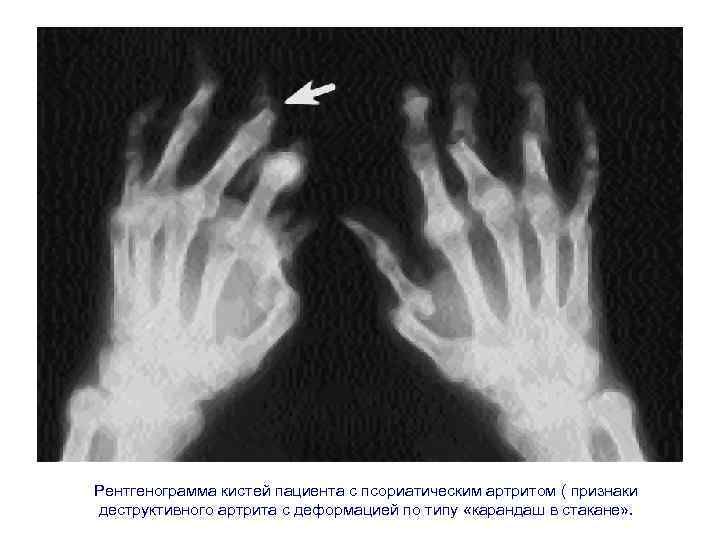 Рентгенограмма кистей пациента с псориатическим артритом ( признаки деструктивного артрита с деформацией по типу