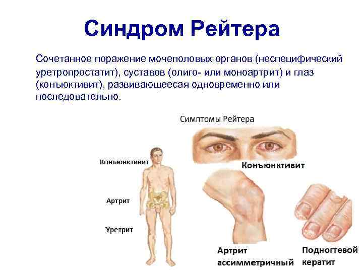 Синдром Рейтера Сочетанное поражение мочеполовых органов (неспецифический уретропростатит), суставов (олиго- или моноартрит) и глаз