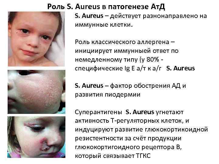  Роль S. Aureus в патогенезе Ат. Д S. Aureus – действует разнонаправлено на