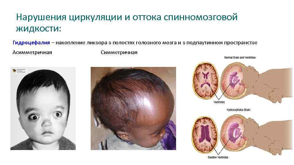 Нарушения циркуляции и оттока спинномозговой жидкости: Гидроцефалия – накопление ликвора в полостях головного мозга