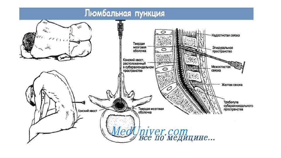 Люмбальная пункция показания