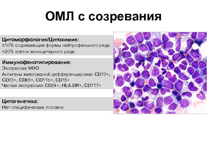 ОМЛ с созревания Цитоморфология/Цитохимия: ≥ 10% созревающие формы нейтрофильного ряда <20% клеток моноцитарного ряда