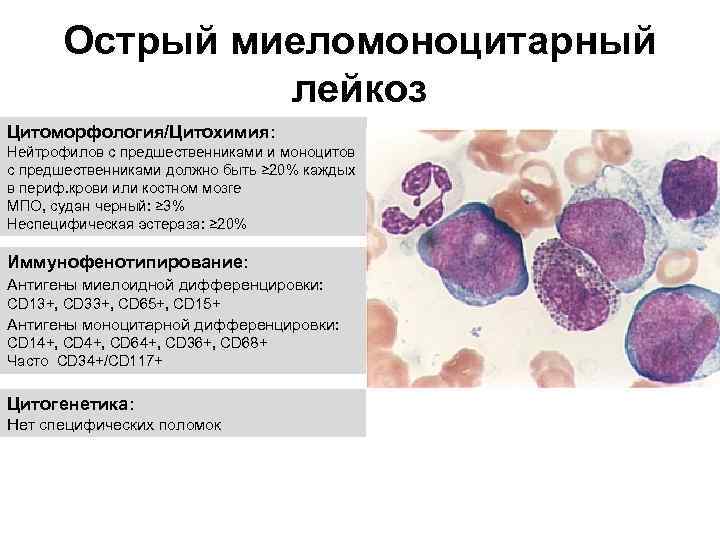 Острый миеломоноцитарный лейкоз Цитоморфология/Цитохимия: Нейтрофилов с предшественниками и моноцитов с предшественниками должно быть ≥