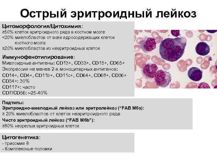 Острый эритроидный лейкоз Цитоморфология/Цитохимия: ≥ 50% клеток эритроидного ряда в костном мозге <20% миелобластов