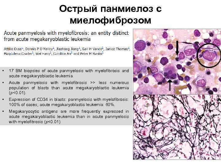 Острый панмиелоз с миелофиброзом • 17 BM biopsies of acute panmyelosis with myelofibrosis and