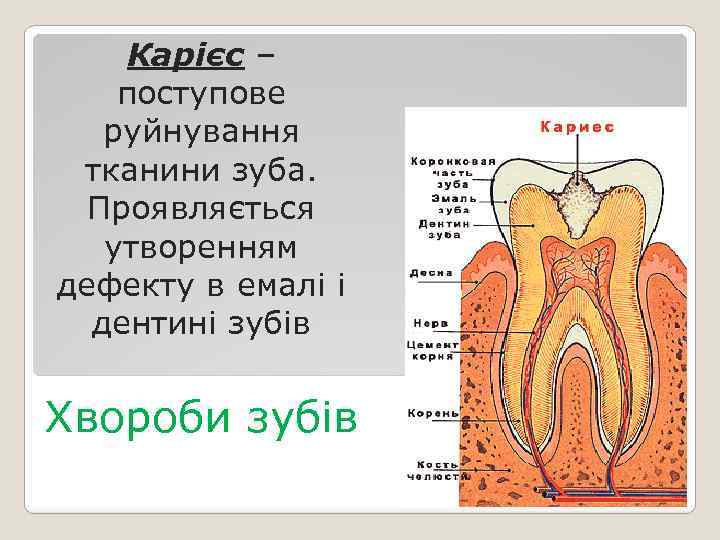 Карієс – поступове руйнування тканини зуба. Проявляється утворенням дефекту в емалі і дентині зубів