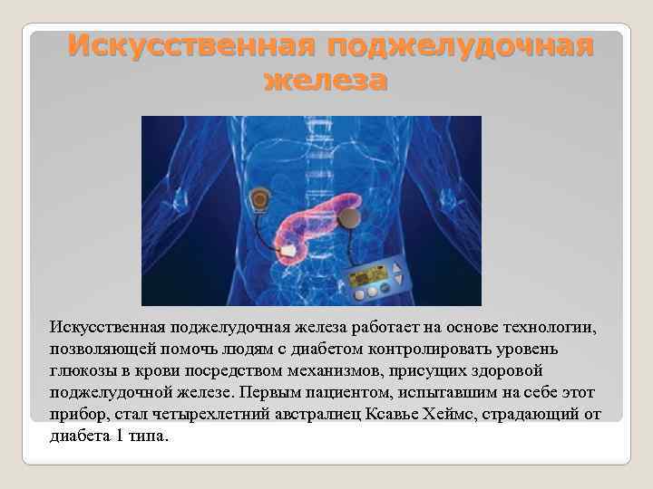  Искусственная поджелудочная железа работает на основе технологии, позволяющей помочь людям с диабетом контролировать