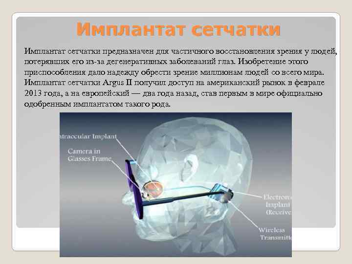 Имплантат сетчатки предназначен для частичного восстановления зрения у людей, потерявших его из-за дегенеративных заболеваний