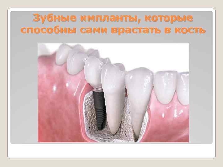 Зубные импланты, которые способны сами врастать в кость 