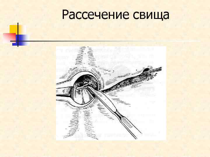 Рассечение свища 