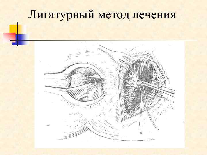 Лигатурный метод лечения 