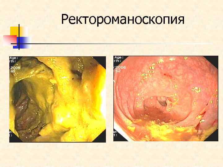 Ректороманоскопия 