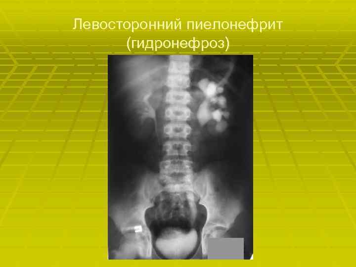 Левосторонний пиелонефрит (гидронефроз) 