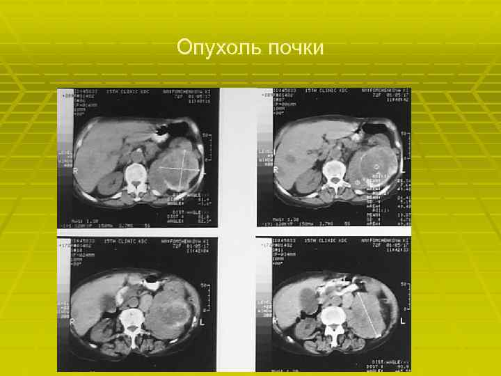 Опухоль почки 