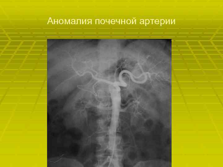 Аномалия почечной артерии 